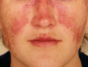 风湿病的皮肤症状