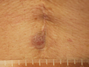 风湿病的皮肤症状